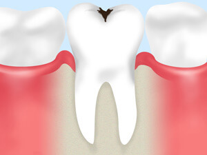 CC1：エナメル質のむし歯